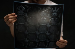 TRANSALC study uses brain imaging to test treatments
